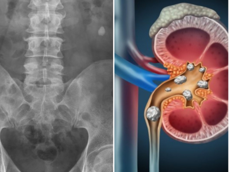 kidney staghorn calculus